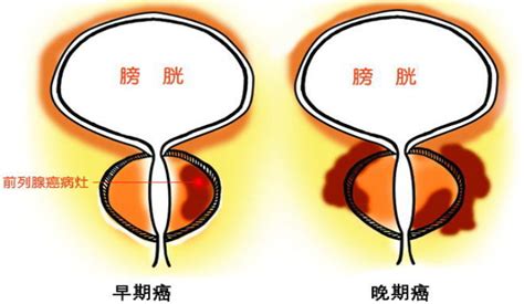 前列腺癌症状有哪些？